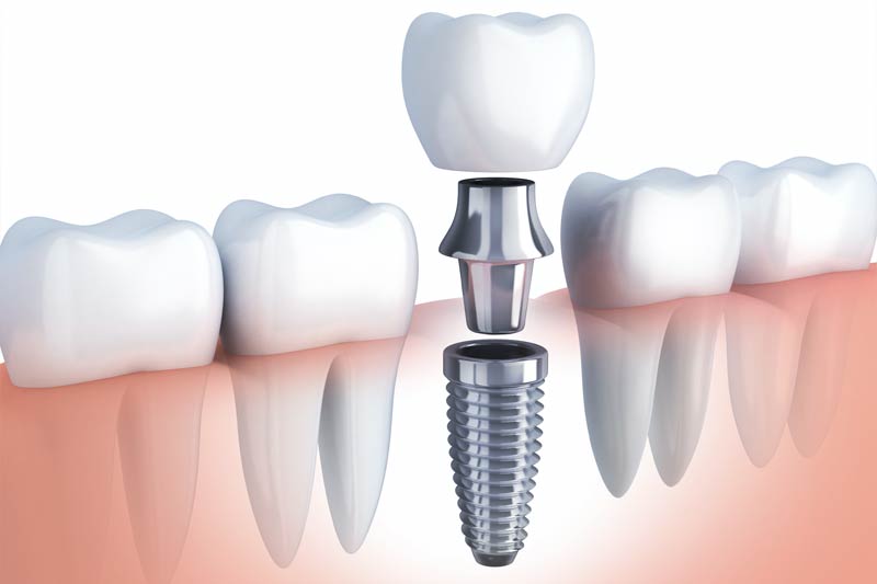 Taunton dental-implants